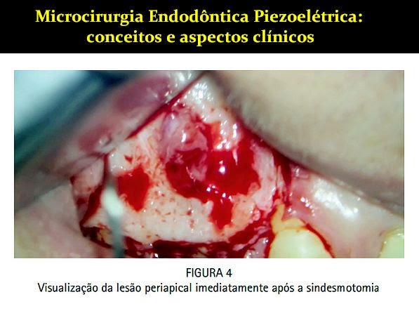 microcirugia-endodontica
