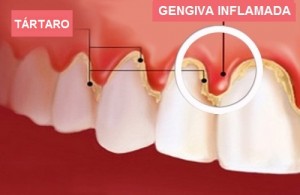 Gingivitis1-500x3251-300x195